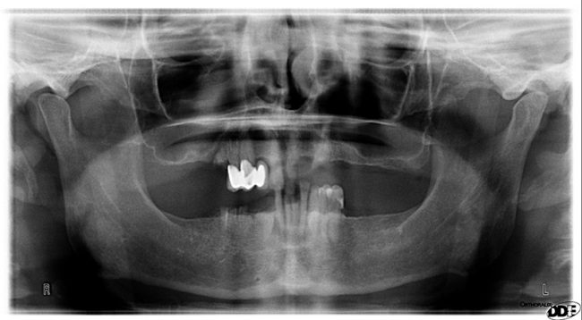 All on 4 Dental Implants David X-Ray