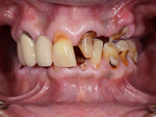 All on 4 Dental Implants Image 2