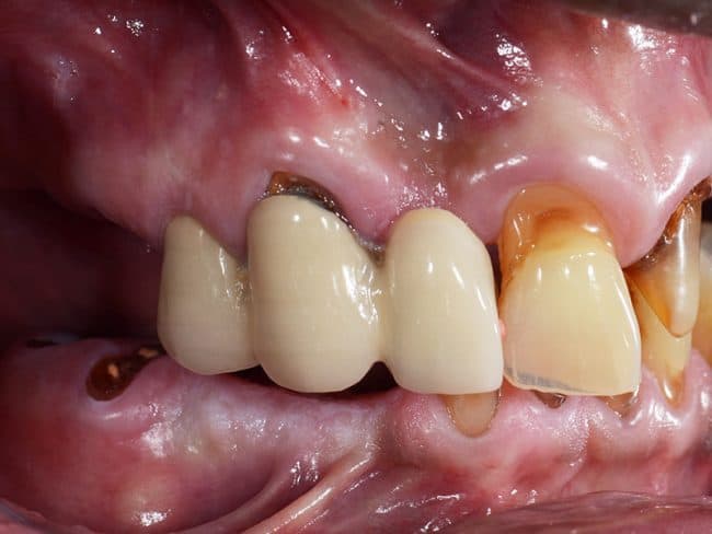 All on 4 Dental Implants Image 3