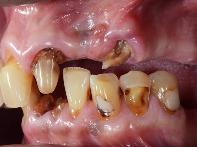 All on 4 Dental Implants Image 4