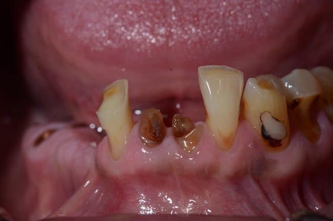 All on 4 Dental Implants Image 5