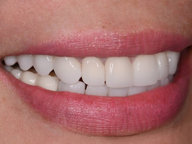 Gloria Side Teeth