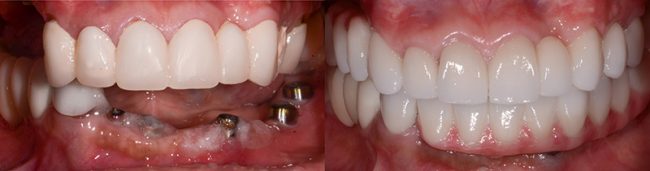 Gloria Teeth Before And After