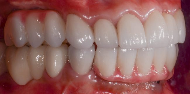 Gloria side Teeth Before Reconstruction