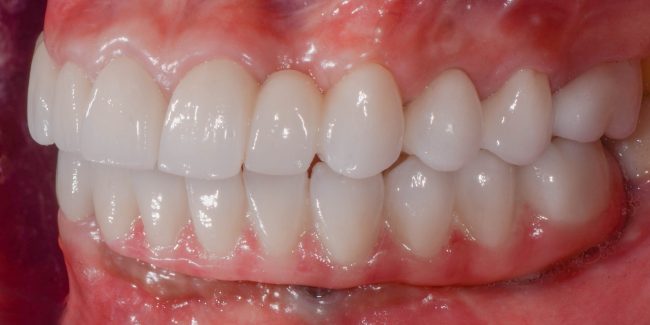Gloria side Teeth After Reconstruction